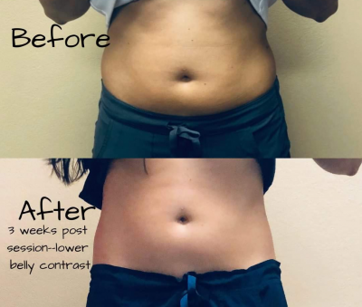 Your Best Body Today Announces Contrast Contouring - the Newest Breakthrough Technology in Fat Freezing