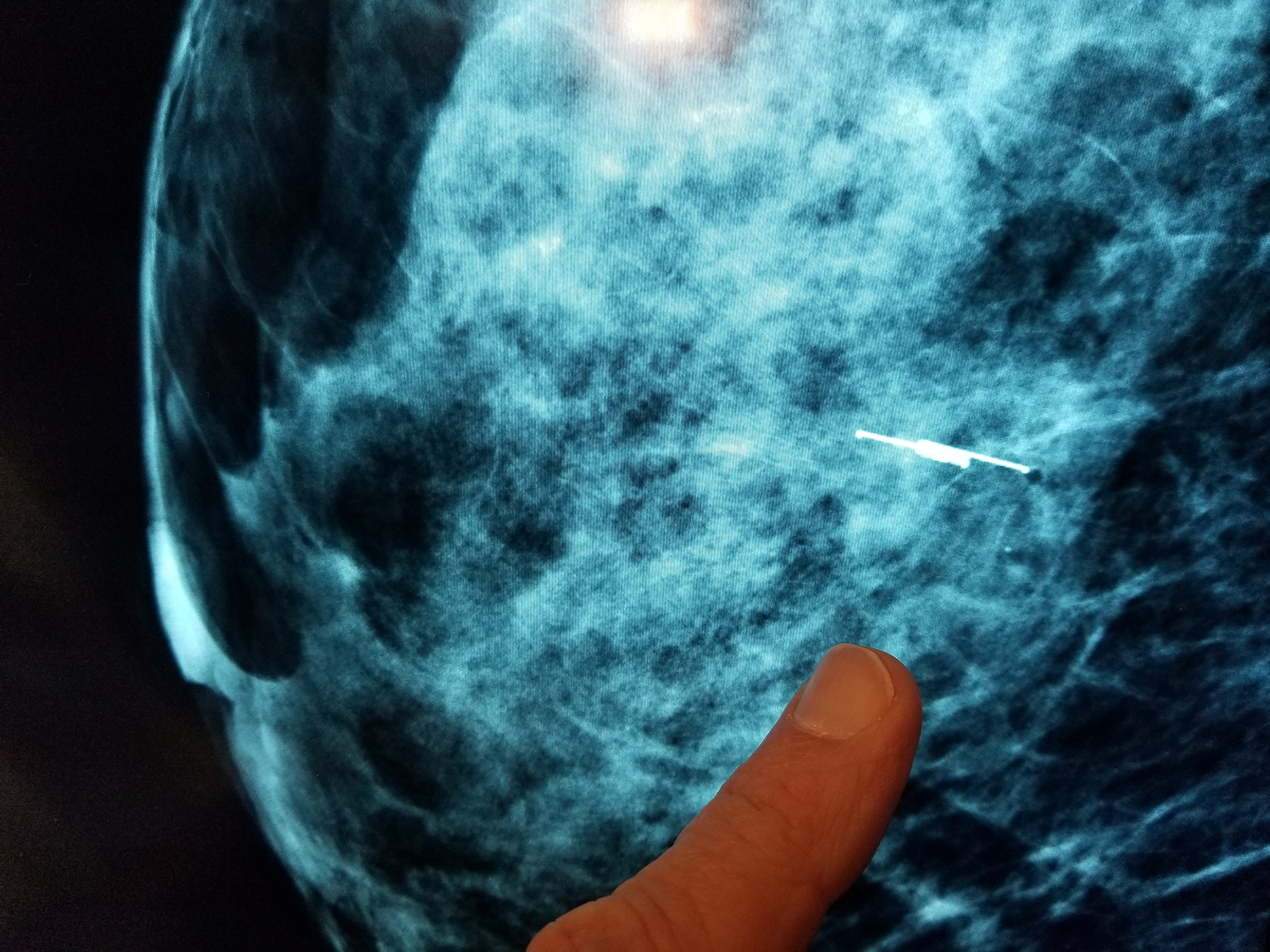 Intermountain Healthcare Using New Process and Technology to Find Breast Tumors Faster, Reducing Discomfort and Cost for Patients