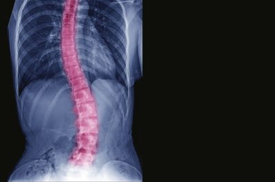 The Center Oregon Explains Surgical Vs. Nonsurgical Options to Treat Scoliosis