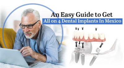 Getting All on 4 Dental Implants in Mexico and Other Dental Procedures Was Never So Accessible (Source: Trust Dental Care)