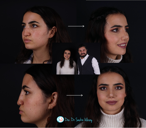 Top-Notch Rhinoplasty in Turkey with Assoc. Prof. Dr. Seçkin Ulusoy