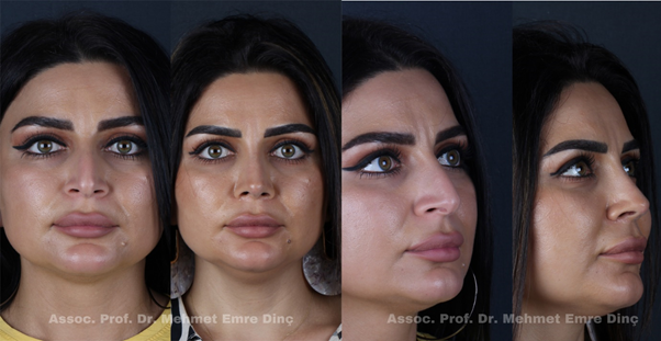 Prof. Dr. Mehmet Emre Dinç Clinic - Everything you need to know about Rhinoplasty in Turkey