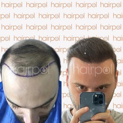 Hair Transplant at the Hairpol Clinic