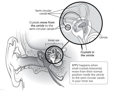 Treatments for The Most Common Type of Vertigo by Intermountain Health