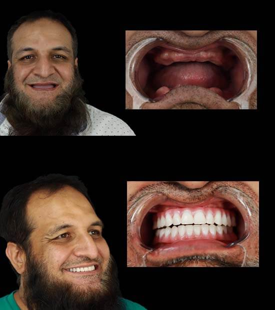 Smile 4 Ever Mexico: Why Choose Tijuana Dental Implants - How To Get Low Cost