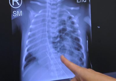Treating Babies with Congenital Diaphragmatic Hernia at Intermountain Primary Children’s Hospital