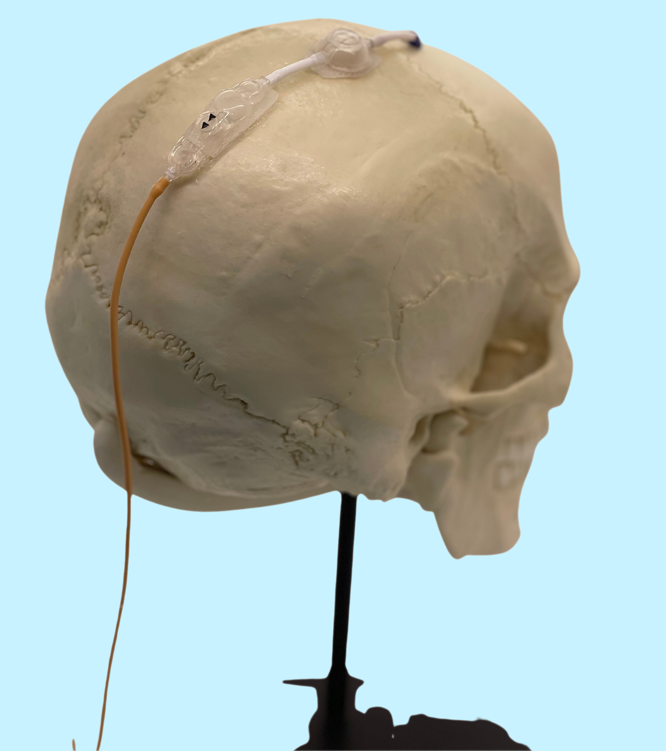 Intermountain Primary Children’s First to Implant Brain Shunt Accessory for Hydrocephalus