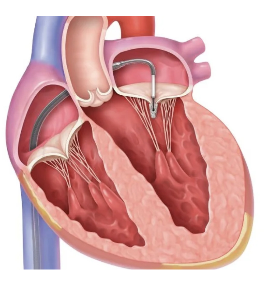 Northern Utah Patients Now Access Lifesaving Heart Valve Procedure Through Intermountain McKay-Dee