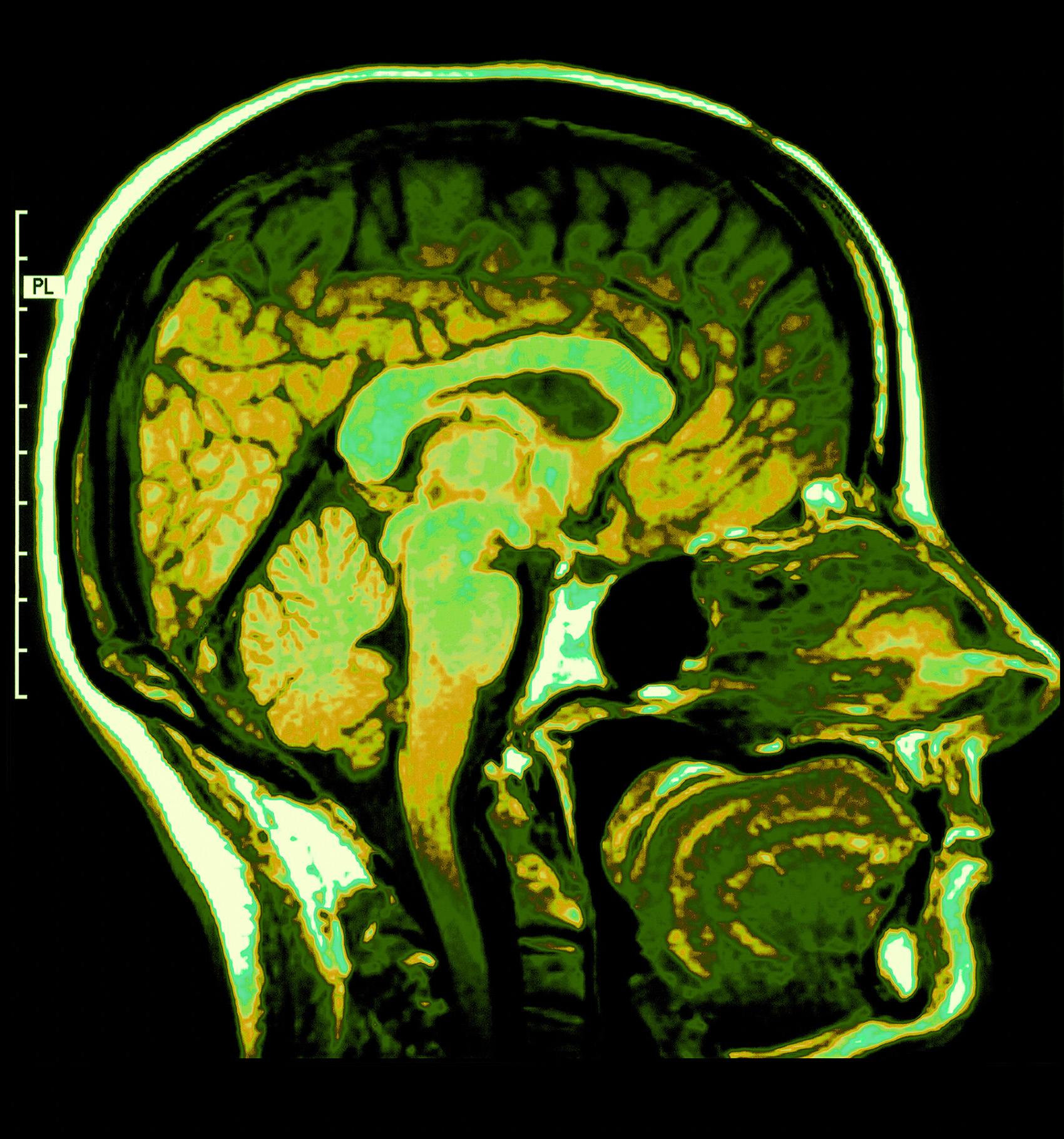 New Intermountain Study Finds That Locally Tailored Stroke Protocols Improves Outcomes