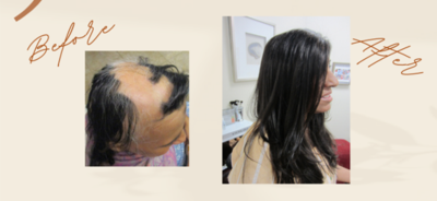 5 Signs You Know You're Ready for Non-Surgical Hair Replacement with Thursday’s Calabasas
