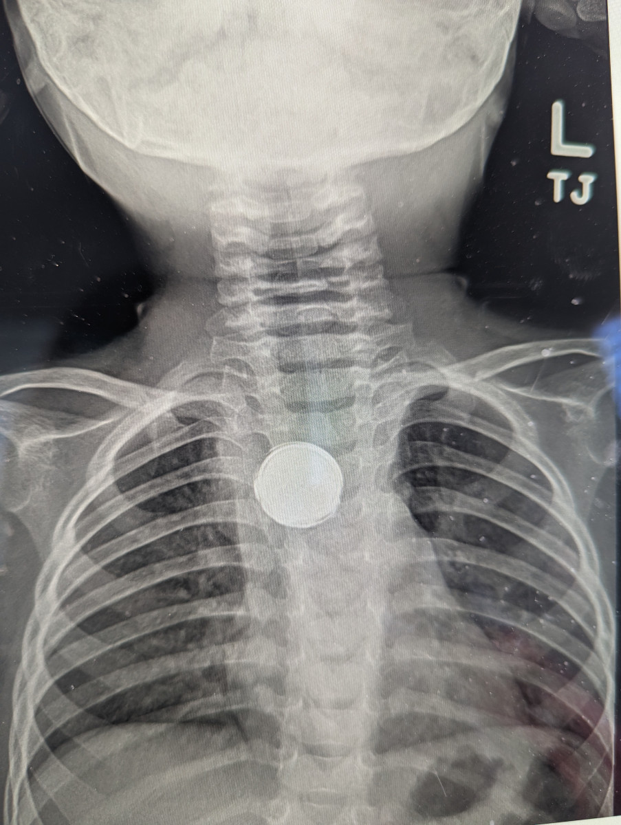 Trauma Surgeons at Intermountain Primary Children’s Hospital Warn Parents About Dangers of Certain Toys