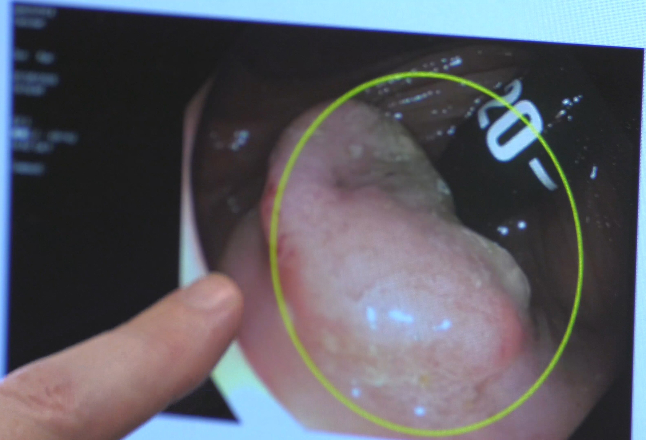 Preventable, Treatable, and Beatable: Intermountain Health Experts Talk Colon Cancer