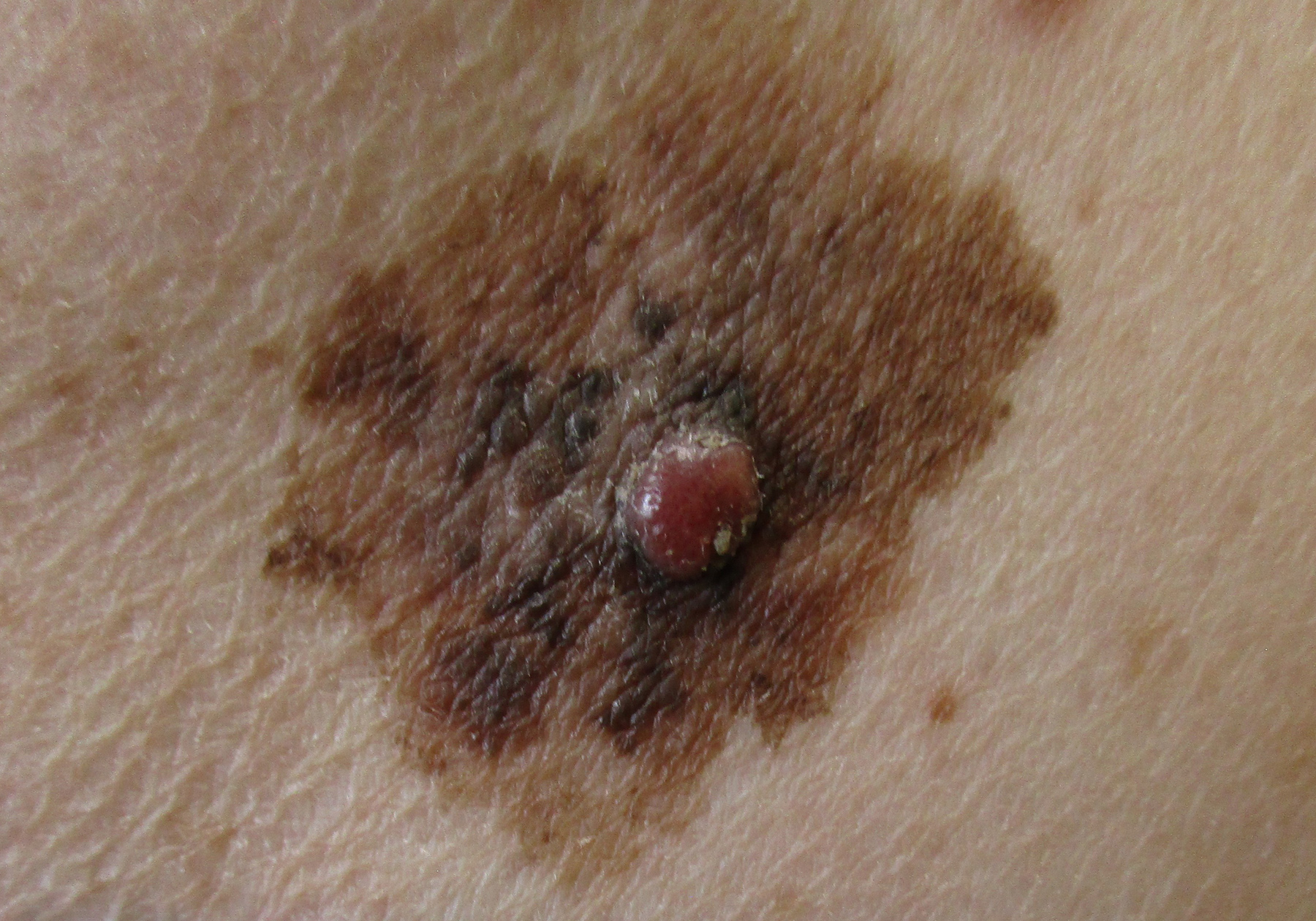 Intermountain Health First in Utah to Use Groundbreaking Treatment for Advanced Melanoma Patients