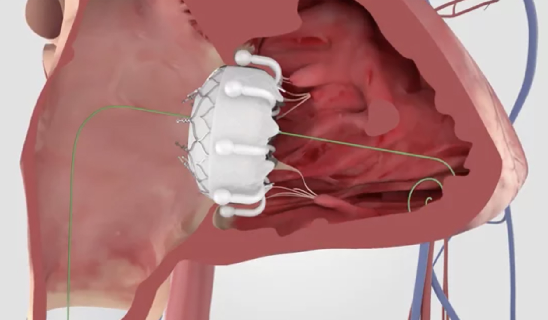 Intermountain St. George Regional Achieves Medical Milestone with Region’s First Cardiac Procedure