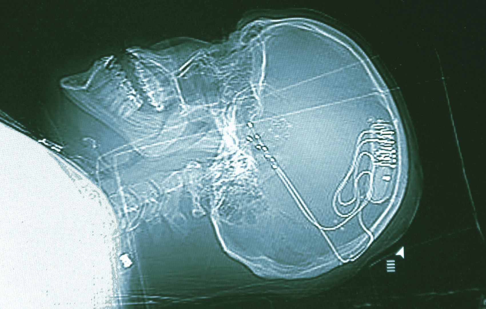 Using Brain Implants, Intermountain Health Performs 100th Procedure to Reduce Epilepsy Seizures